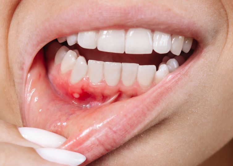 過蓋咬合を放置した場合のリスク