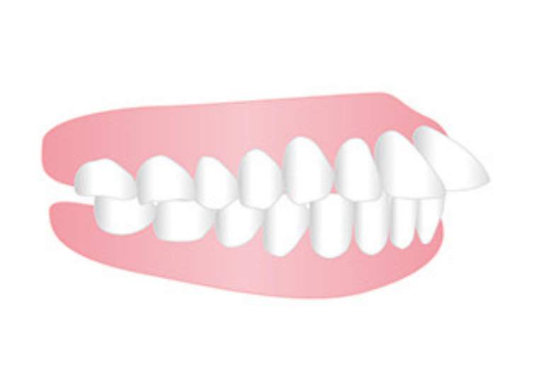 出っ歯（上顎前突）の状態イメージ