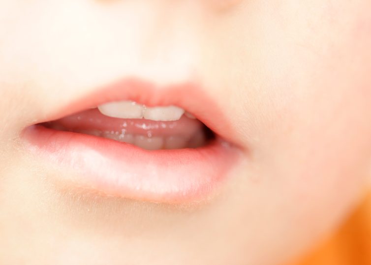 出っ歯の原因イメージ