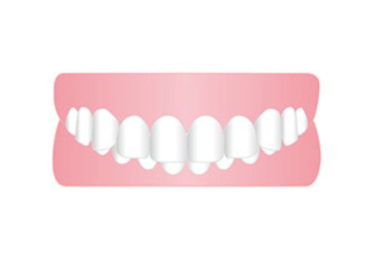 過蓋咬合の状態イメージ